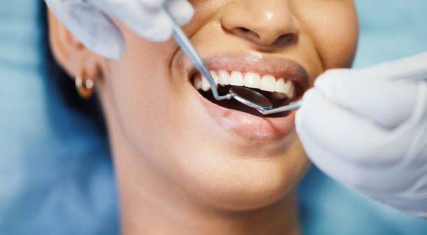 Best Knocked-Out Tooth (Avulsed Tooth) Treatment in Atlanta, GA